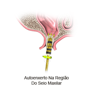 Levantamento de Seio Maxilar Intra Alveolar